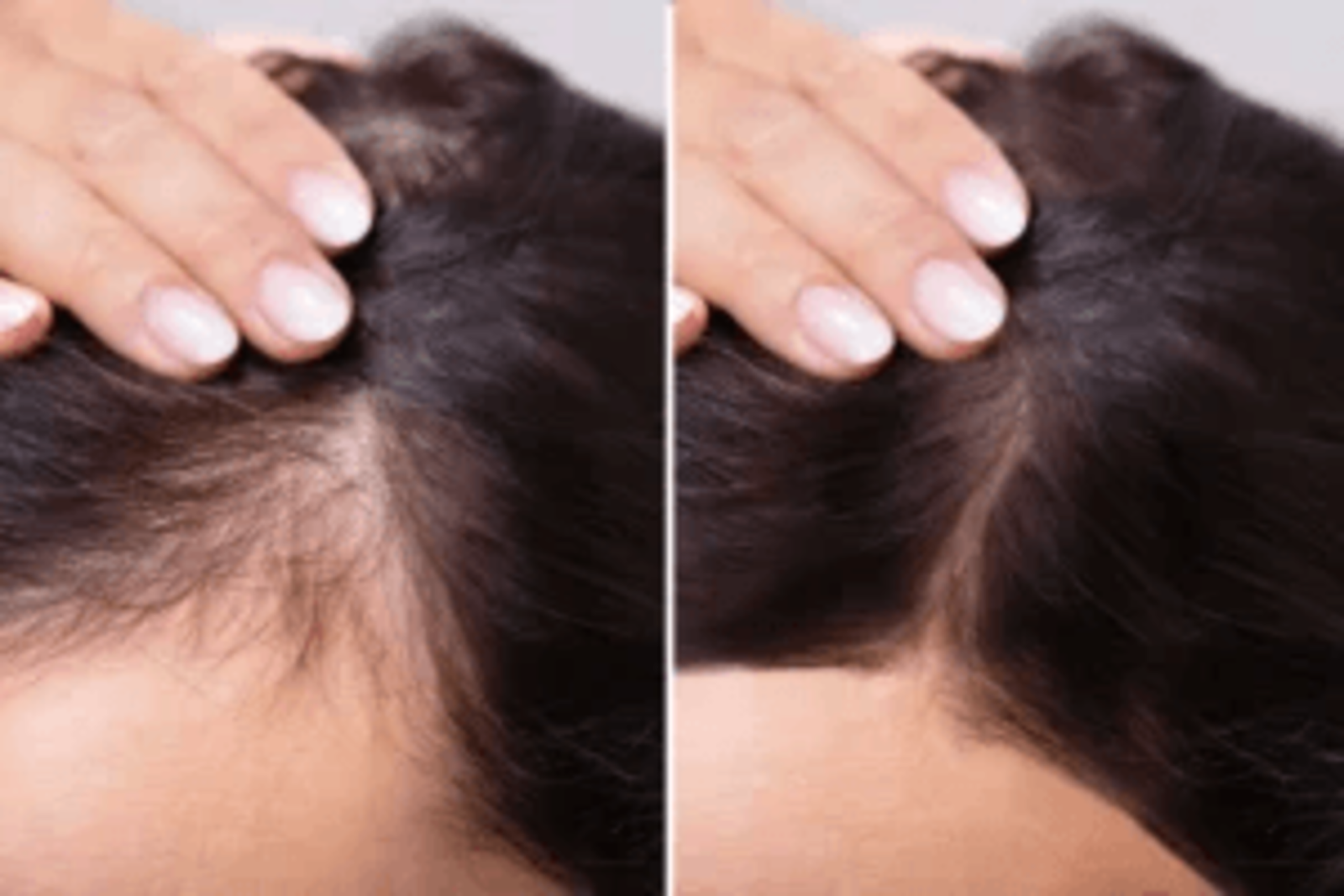 Combatting Hair Loss: Unique Treatments at Nava Wellness